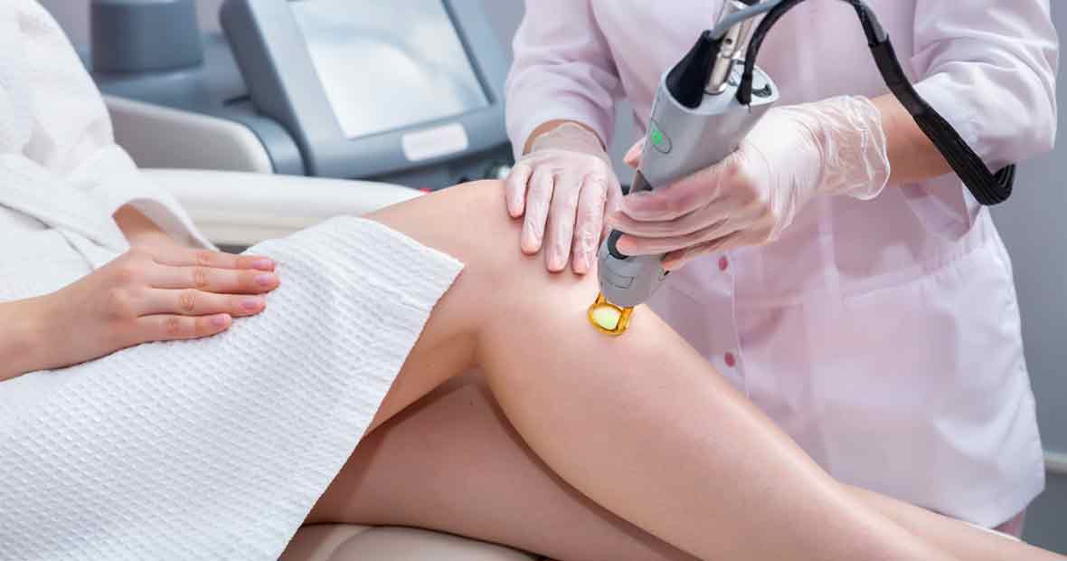 épilation laser