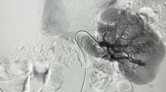 embolisation-une-technique-mini-invasive-pour-traiter-efficacement-de-nombreuses-pathologies