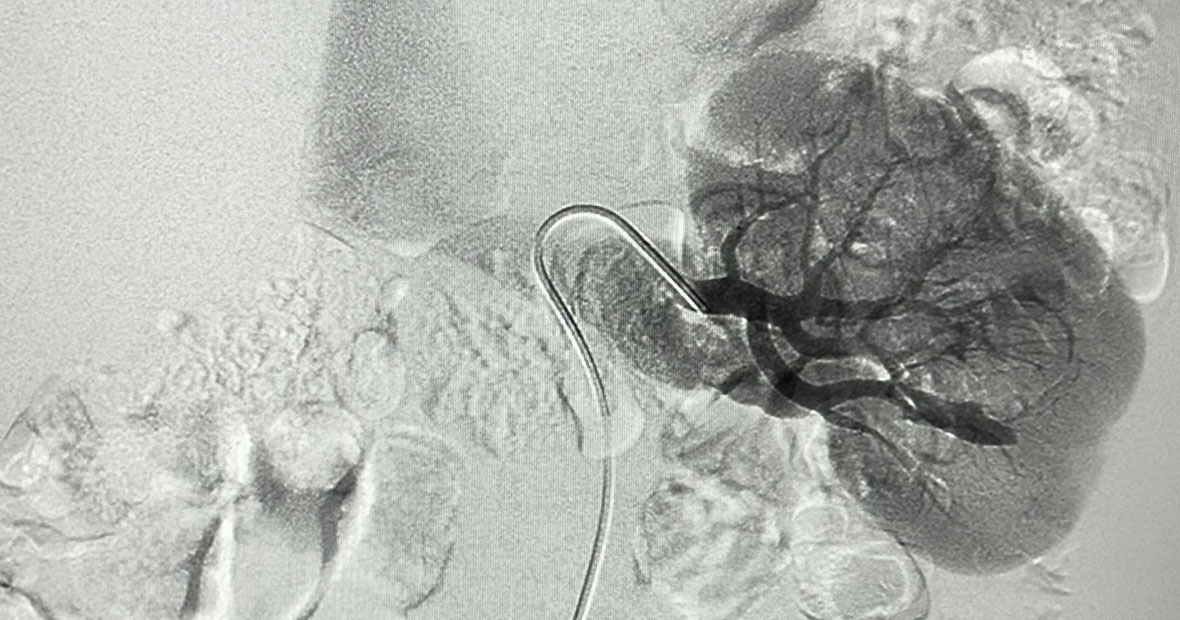embolisation-une-technique-mini-invasive-pour-traiter-efficacement-de-nombreuses-pathologies